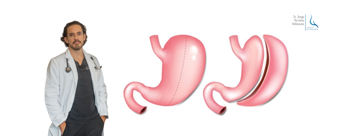 ¿Miedo a la Cirugía Bariátrica? 5 mitos y realidades del Bypass Gástrico