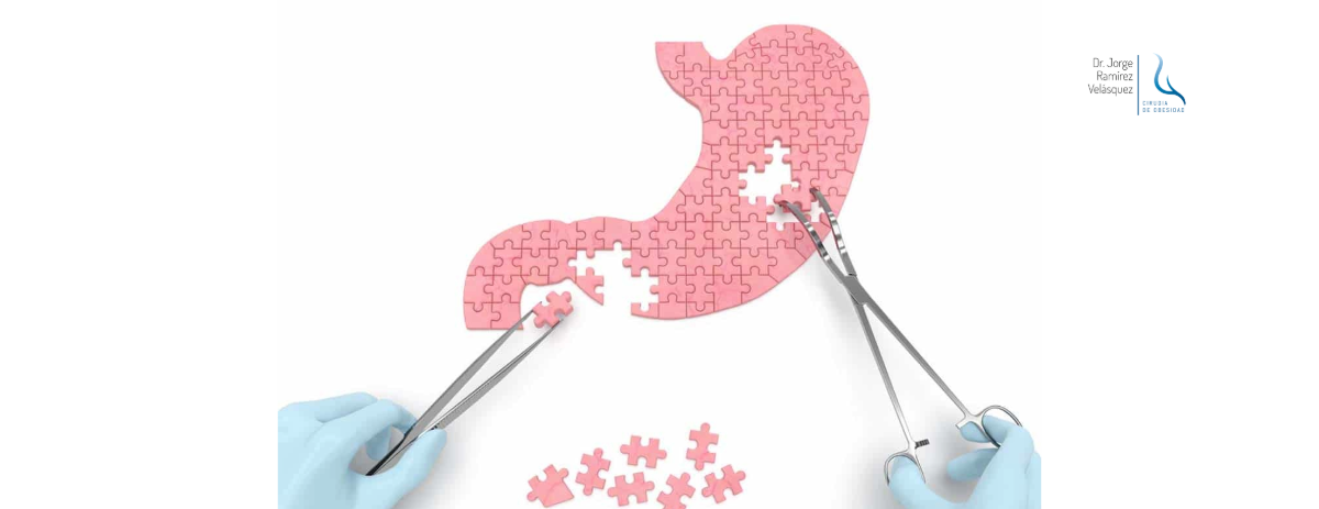 Tienes Diabetes Tipo 2? Así Funciona la Cirugía Metabólica para Controlarla