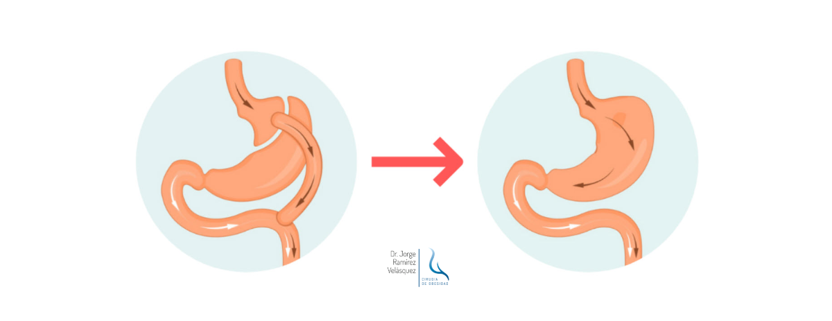 Bypass Gástrico: ¿Es Reversible, Ajustable o Permanente? Explicación Completa