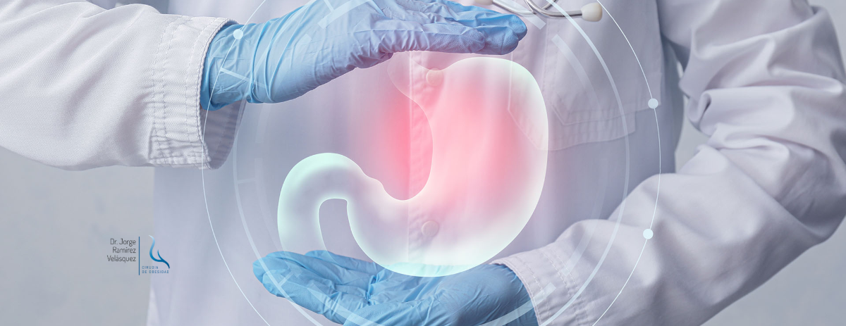 ¿Es Reversible el Bypass Gástrico? Lo Que Debes Saber Antes de Decidir